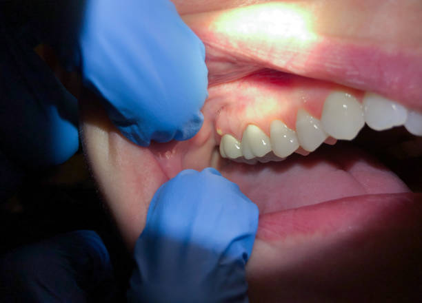 Best Emergency Treatment for Dental Infections or Abscesses in Menasha, WI